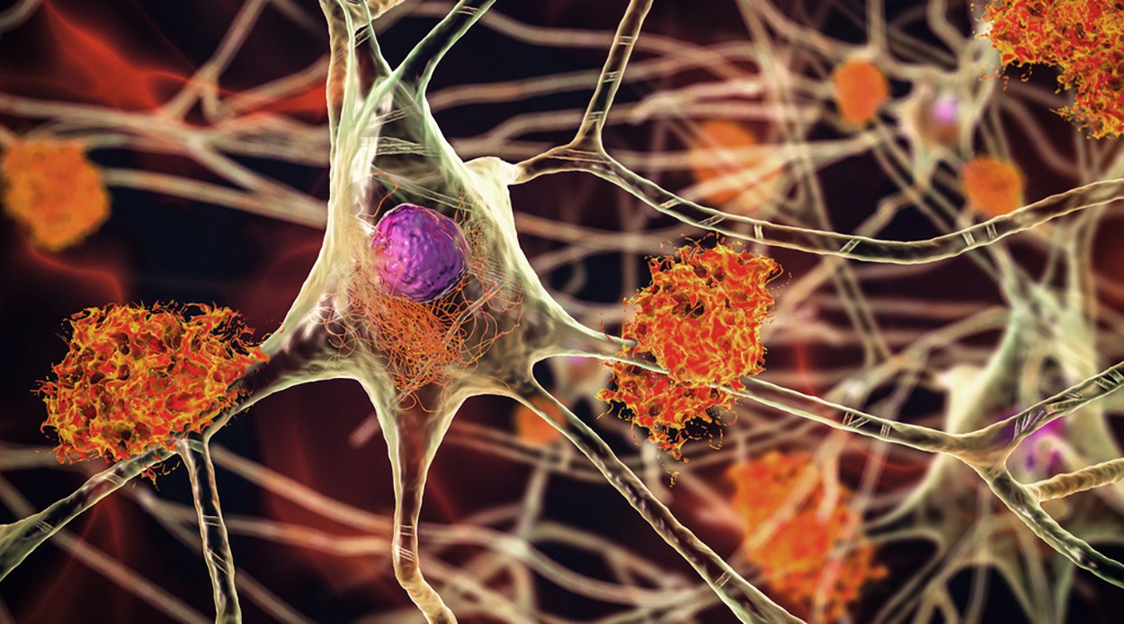 Alzheimer: Wirkstoffe gegen Tau-Fibrillen im Test